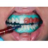 Ultradent - λευκανση - δοντια - Opalescence Boost PF 40% 4 Ασθενών - Λεύκανση ιατρείου  Opalescence Boost 40% - Λεύκανση δοντιών στο ιατρείο